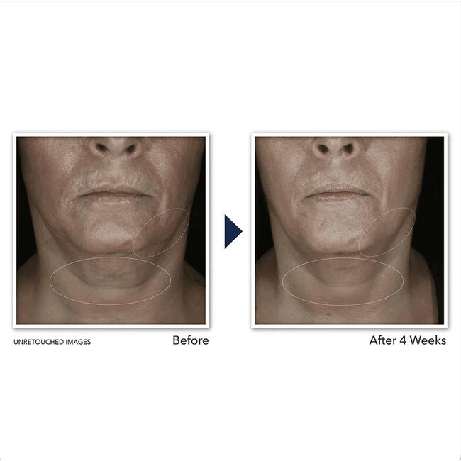RoC Derm Correxion Contour Cream 50 ML