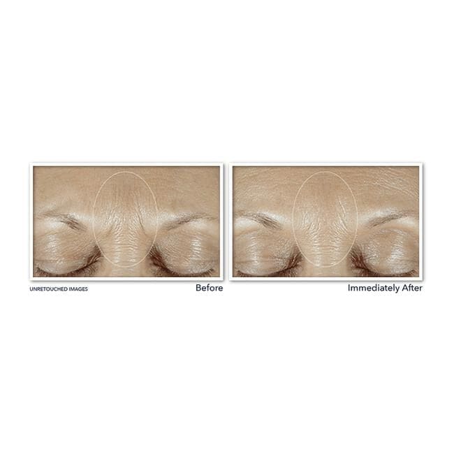 RoC Derm Correxion Fill + Treat Serum 15 ML