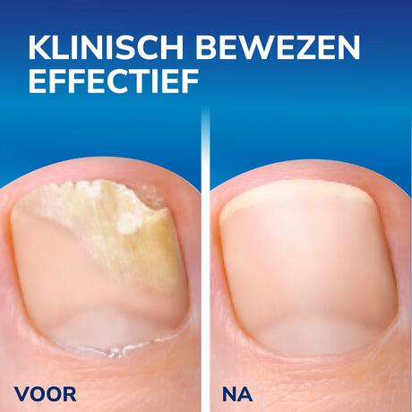 Dr.Scholl's Kalknagel 2-in-1 Behandel & Bescherm met 5 wegwerpvijltjes