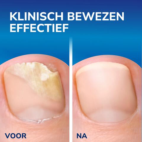 Dr.Scholl's Kalknagel 2-in-1 Behandel & Bescherm met 5 wegwerpvijltjes