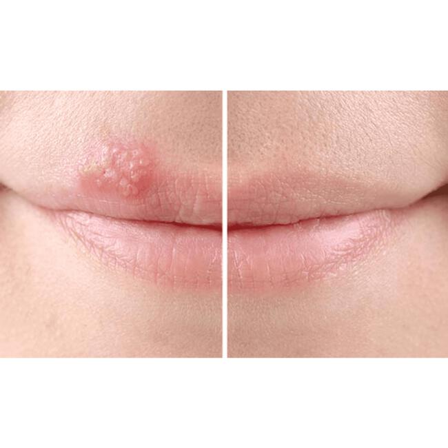 SoreFix Duo Patch voor Koortslip behandeling Ultradun, Transparant, Hypoallergeen 15 stuks