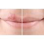 SoreFix Duo Patch voor Koortslip behandeling Ultradun, Transparant, Hypoallergeen 15 stuks