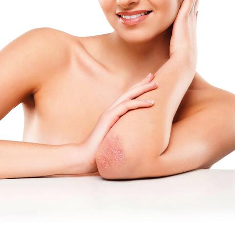 Lucovitaal Eczeem Psoriasis Intensive Cream