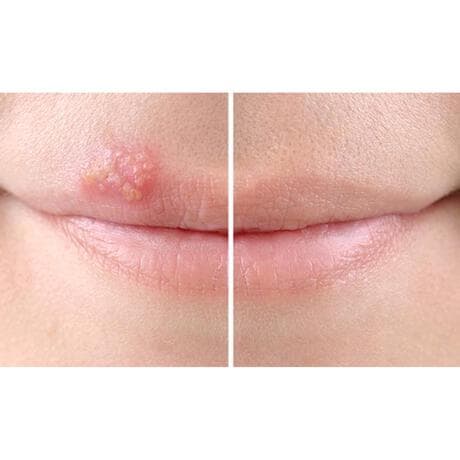 SoreFix Duo Patch voor Koortslip behandeling Ultradun, Transparant, Hypoallergeen 15 stuks