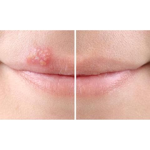 SoreFix Duo Patch voor Koortslip behandeling Ultradun, Transparant, Hypoallergeen 15 stuks