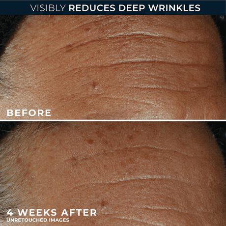 RoC Derm Correxion Fill + Treat Serum 15 ML