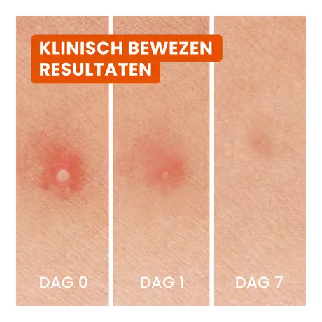 Biore Hydrocolloid Patch 24 stuks
