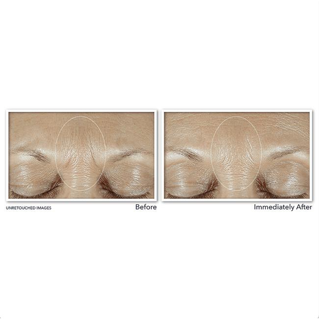 RoC Derm Correxion Fill + Treat Serum 15 ML