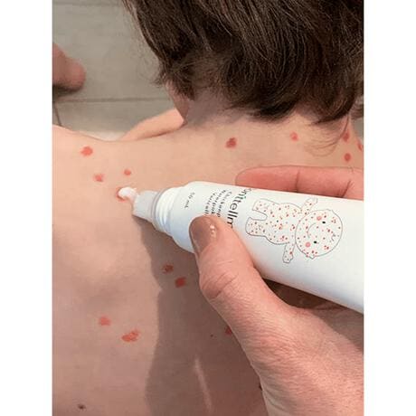 donttellmum Waterpokken Behandeling 50 ML