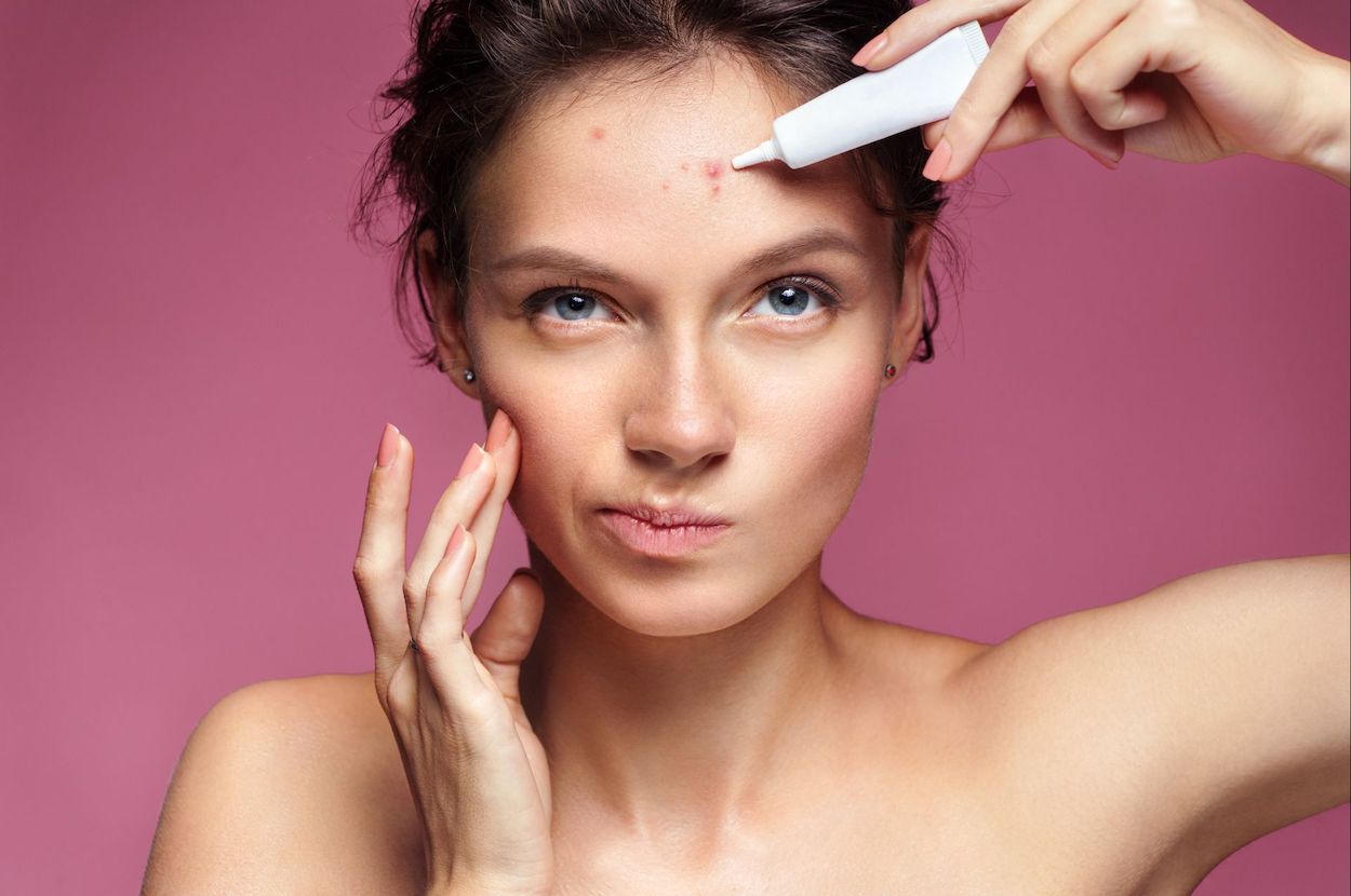 vrouw met acne brengt crème aan op haar gezicht