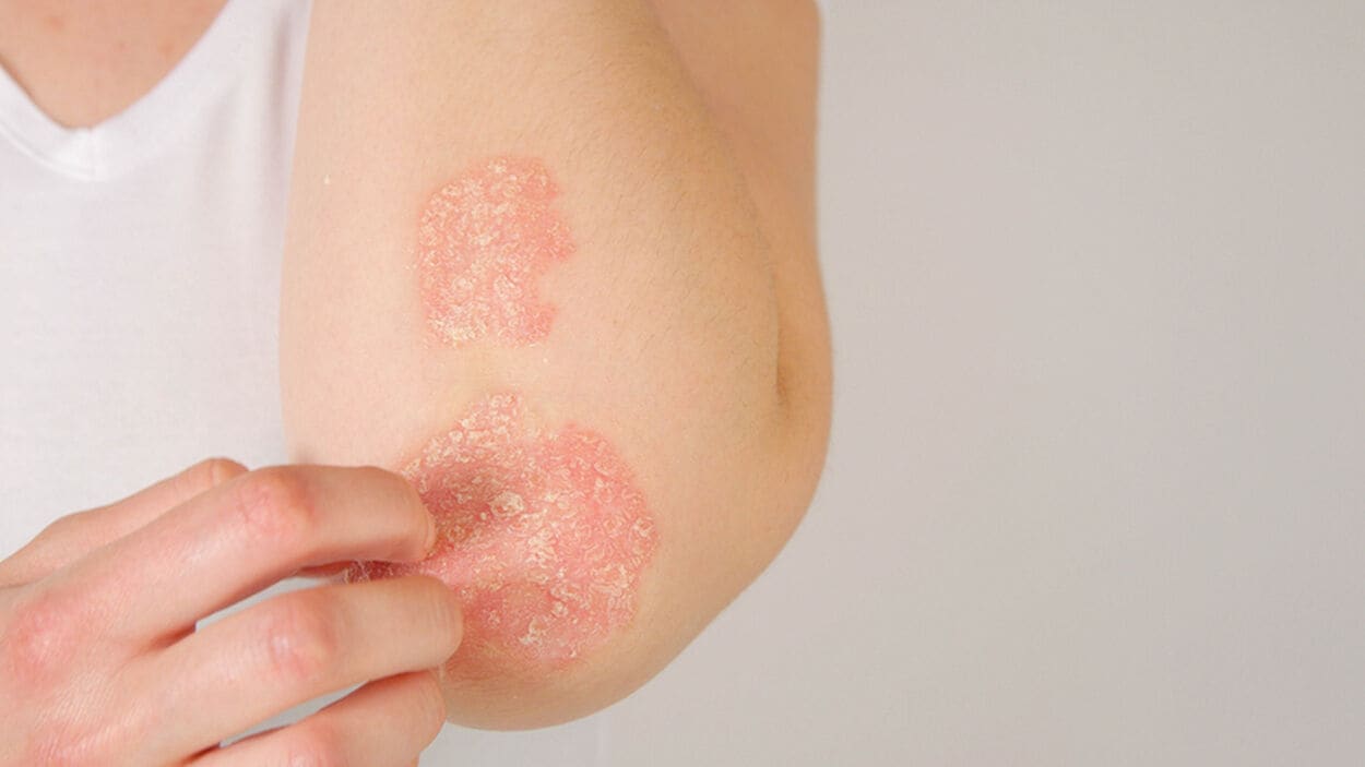 Vrouw die psoriasis op haar arm heeft.