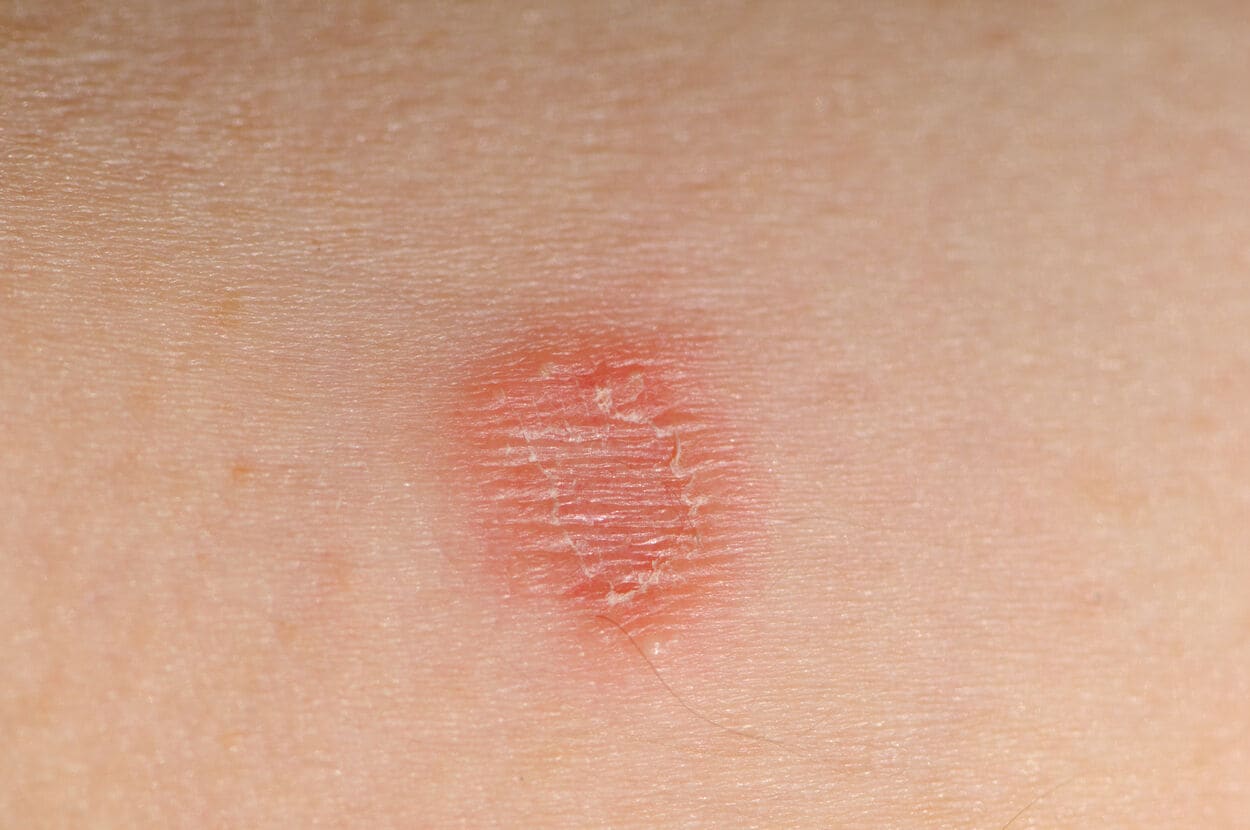Foto van een arm met ringworm (schimmelinfectie)