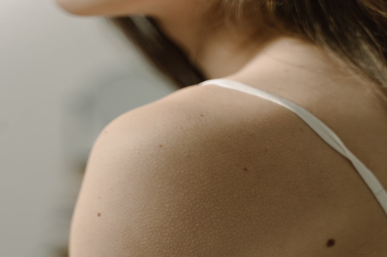 Arm met kippenvel