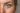 verschil tussen acne en rosacea