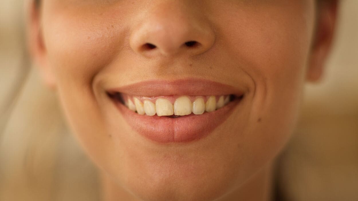 Lach van een gebit van een vrouw met tanderosie.