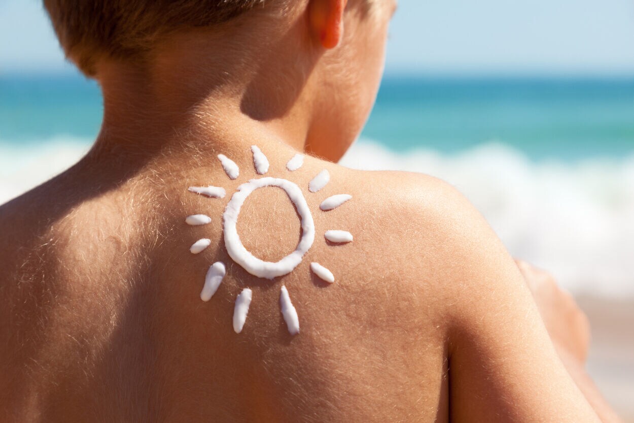 kind met zon van zonnebrand op huid
