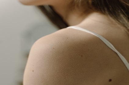 Keratosis pilaris: een aandoening die bultjes en een ruwe huid veroorzaakt