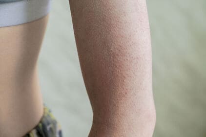 Keratosis pilaris: een aandoening die bultjes en een ruwe huid veroorzaakt