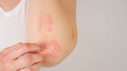 Psoriasis? Wat is het en hoe behandel je het?