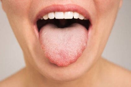 Witte tong? Dit zegt het over je gezondheid!
