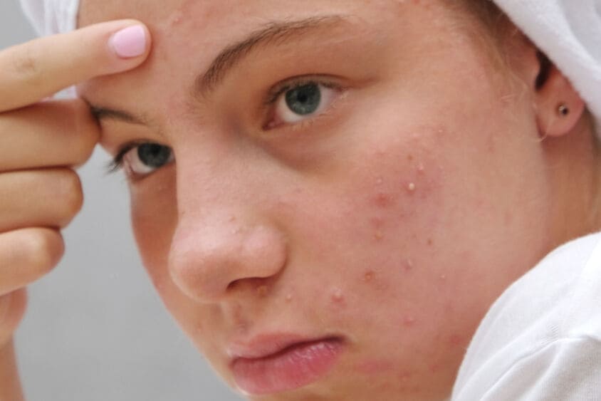 Steenpuist: hoe kom je er vanaf? | Etos