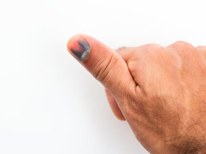 Bloeduitstorting onder je nagel: dit kan je doen