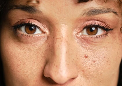 vrouw die recht in camera kijkt met vlekjes op het gezicht