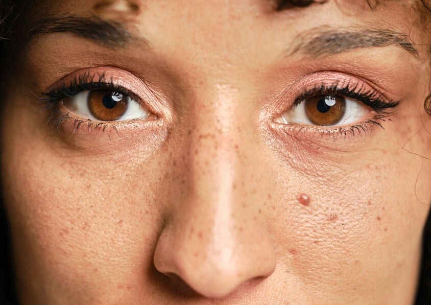 Steenpuist: hoe kom je er vanaf? | Etos