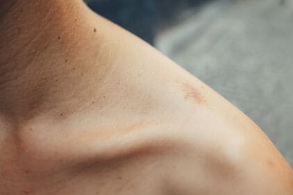 Spanningshoofdpijn: wat helpt tegen spanningshoofdpijn?