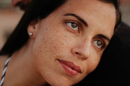 Hormonale acne: wat is het en hoe kom je ervan af?